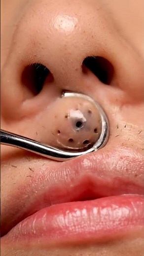 Triggers Only! ASMR Metal Loop Extraction on Upper Lip | Sebum Pops (Pure Sounds) #shorts #asmrs