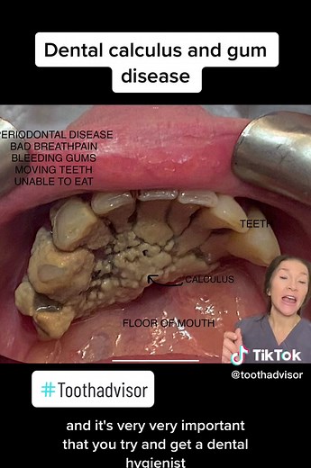 ❤️Calculus - tartar, whatever you call it - is pretty desperate stuff and hard to remove, if not impossible to remove 🙈Is it Dangerous 🦷Left, it will grow to involve the gum, cause inflammation and 🦷🦷 Erodes the bone ✅The teeth will loosen 🦷the teeth become sensitive ✅The teeth Move 🦷Bad breath follows ✅Bleeding gums 🙈Pain 🙈In a nutshell - not good stuff So how do you prevent ❄️Brush Daily ❄️Floss ❄️Use interdental brushes, and if you still get it - see a dentist Baking soda is a product