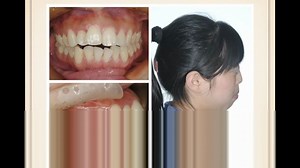 2. 伴TMD症状患者正畸治疗的诊断与临床矫治策略讲师：陈军