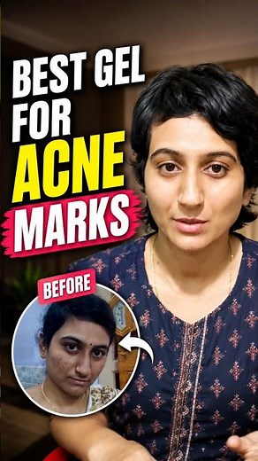 Best gel for acne and acne marks | Before my skin with pimples and pimple marks #acnegel #acnemarks