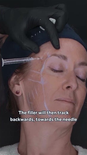 Injecting Temple Filler at a 45 Degree Angle 💎 Evidence-Based Advice for Aesthetic Practitioners