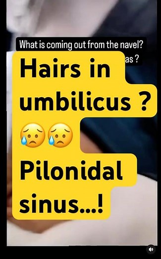 I Found Hair Inside the Belly Button. What I Discovered Shocked Me! Pilonidal sinus