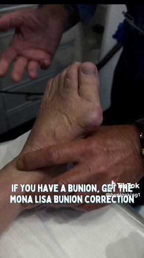 Say goodbye to bunions with the MONA LISA Bunion Correction! 👉 No incisions, just small pokes 🧰 No pins, screws, staples, stitches, wires, or plates 💉 No general anesthesia or sedation 🙅‍♂️ No downtime 🦵 Ability to walk immediately after procedure 🩼 No casts, crutches, tourniquets or bulky plastic boots 🌟 Results: Immediate 🏃‍ Ability to return to normal activities quickly 💊 No narcotics or opioids required - very little pain 🏥 No hospital stays 🩺 No doctor's referral needed ⏳ Procedu