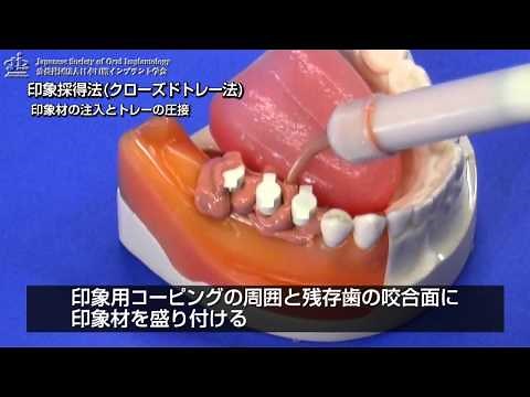 04印象採得クローズドトレー法