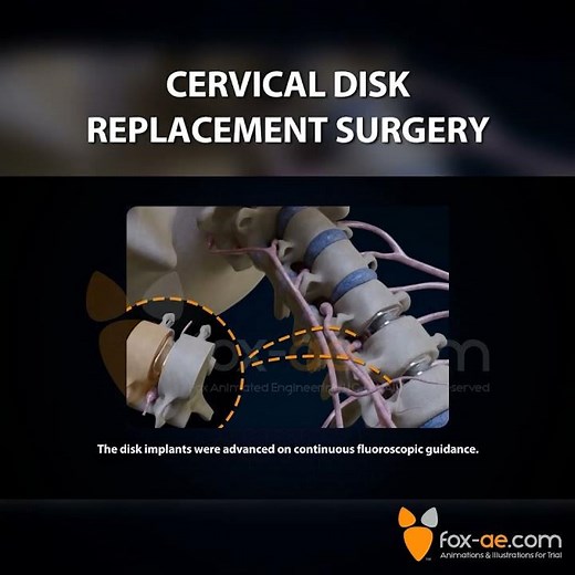 Cervical Disk Replacement Surgery