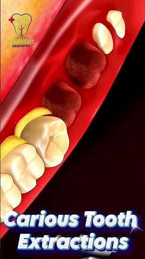 Immediate Implant Placement After Tooth Extraction
