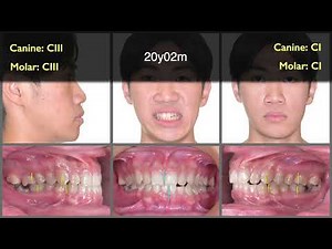 Solving impacted lower molars, Part I | 【Chris Chang Ortho】CC823