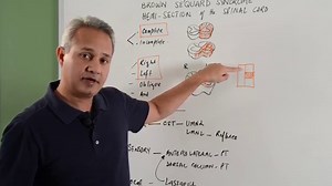 Brown Sequard Syndrome