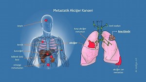 Metastaz Nedir? Metastaz Belirtileri, Kanser Neden Metastaz Yapar | Prof. Dr. Mustafa ÖZDOĞAN