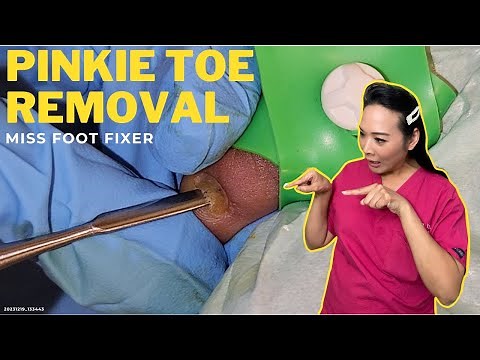 How To Safely Remove A Damaged Little Toenail: A Step-By-Step Guide | Miss Foot Fixer