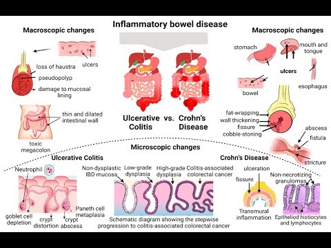 Pathogenesis and morphology of Inflammatory Bowel Disease