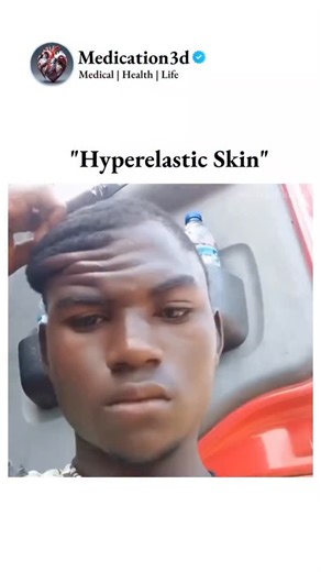 Medical | Health | Life on Instagram: "Hyperelastic skin, also known as Ehlastosis, is a condition where the skin is extremely flexible and can be stretched far beyond normal limits. This is often seen in Ehlers-Danlos syndrome, a genetic disorder affecting connective tissue. People with hyperelastic skin might experience joint hypermobility and fragile skin that's prone to injury. #hyperelastic #skincare #hypermobility #medical #explorepage #skincaretips"
