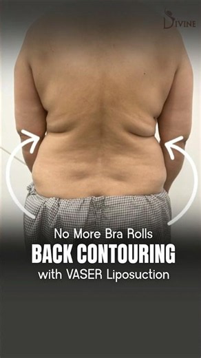 Back Liposuction Before and After | Back Fat Reduction #shortsviral