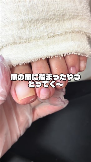 大分で巻き爪、角質ケアしてます😌 冬に溜まった角質 キレイにしましょう😌 #大分市 #大分市角質ケア #大分市巻き爪ケア #大分市ネイルサロン #大分駅