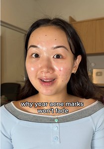 Sunscreen for Acne-Prone Skin: Prevent Dark Spots & Hyperpigmentation