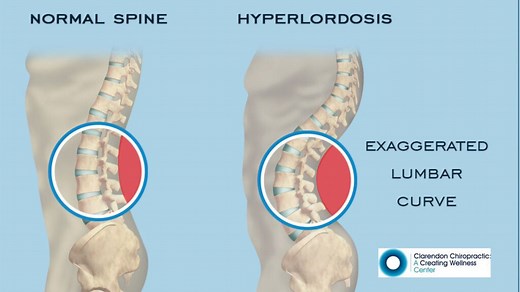 Lumbar Lordosis: Key Symptoms and Chiropractic Solutions