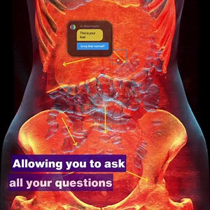 29K views · 260 reactions | Confused by your MRI or CT scan? Ask AI can help — in minutes. ️ Upload your scan (DICOM format) ❓ Ask anything directly on the image  Get clear, AI-generated answers instantly ‍⚕️ Add a radiologist review if you’d like expert confirmation No waiting, no jargon — just real answers.  Upload your scan now and try Ask AI. | Braid Health | Facebook