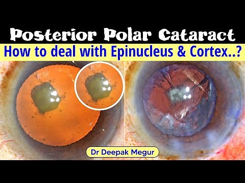 Posterior Polar Cataract. How to deal with Epinucleus & Cortex - Dr Deepak Megur