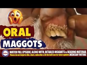 Shocking Maggots in the Mouth: Oral Myiasis Causes, Treatment, and Prognosis 🦠🪰