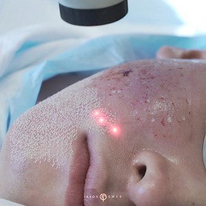 How to Improve Acne Scars | Ablative CO2 laser