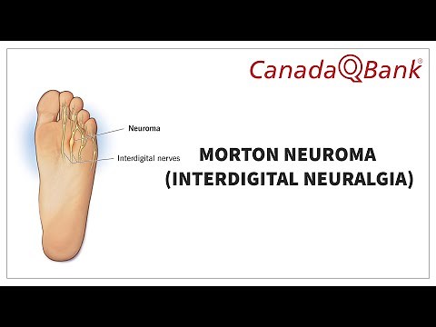 Morton’s Neuroma: Causes, Symptoms, Diagnosis & Treatment | CanadaQBank