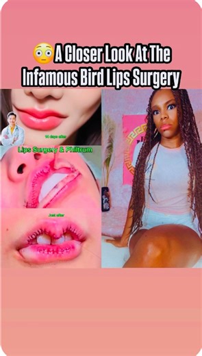 15K views · 20 reactions | The Bird Lip Surgery Originated In Asia. This Surgery has widespread and doesn’t seem to be stopping anytime soon. Share your authentic thoughts, have you heard of this procedure. #Birdlip #lipsurgery #lips #cosmetics #CosmeticSurgery #cosmeticinjectables #liposuction #filler #fillersinjection #fillerbeforeandafter #fillerlips #fillertransformation #fillergoals #bbl #bblsurgery | High Maintenance Care | Facebook