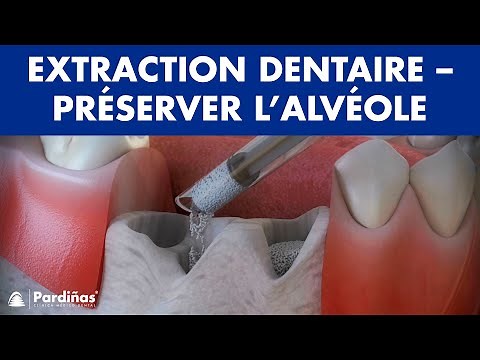 Extraction dentaire – Traitement pour préserver l’alvéole ©