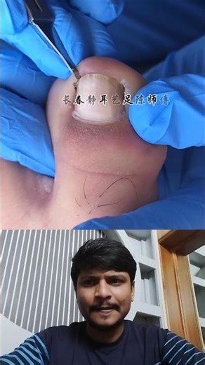 ingrown toenail cleaning asmr #nails #simplenails #satisfying