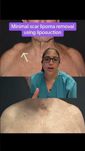 Minimal Scar Lipoma Removal with Liposuction | Dr. Libby Copeland-Halperin #Shorts