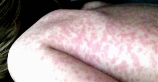 Suburban Chicago counties point finger to city after measles cases are confirmed