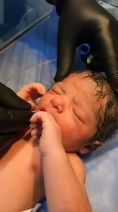 Meconium aspiration syndrome occurs when a newborn breathes a mixture of meconium and amniotic fluid into the lungs around the time of delivery. #baby #babycare #NICUCare #cutebaby #babycute #babycuteness #photographychallengechallenge #feeding #meconium | Ashish Kumar Gautam