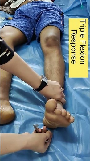 babinski with triple flexion response | complete extensor planatar reflex #neurology #shorts