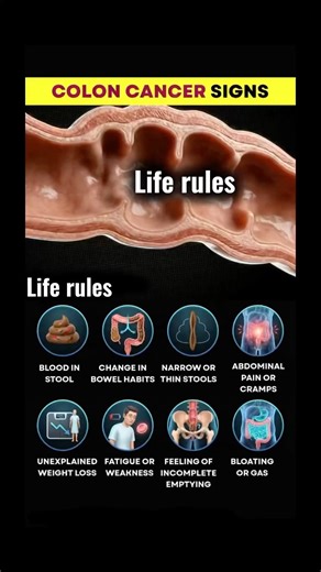 8 Warning Signs of Colon Cancer You Shouldn’t Ignore