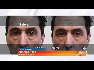 Plexaderm reducing the signs of aging