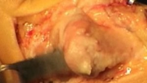 Chevron Shaft Osteotomy for Severe Bunion