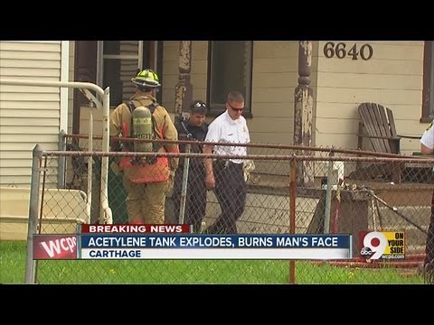 Acetylene tank explodes, burns man's face
