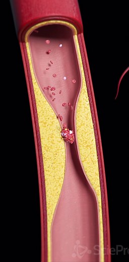ATHEROSCLEROSIS🩸🚫#medical #medicalstudent #sk7t7 #anesthesia #anesthesiologist #doctor #skthetist #blood #heart