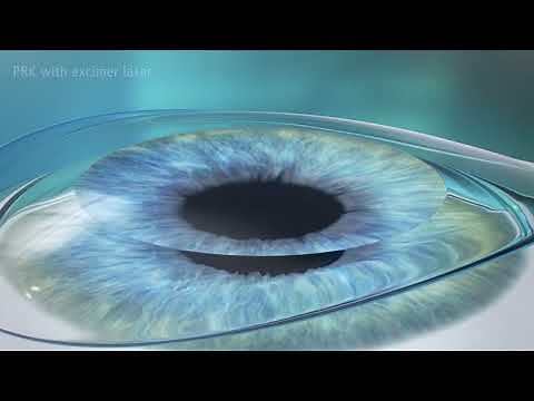 LASEK (PRK) Procedure Animation