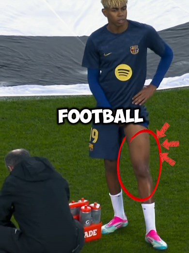 Understanding Bow-Legged Posture in Football Players