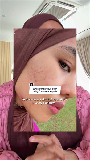 Say Goodbye to Dark Spots: L'Oréal Pink Cream Routine