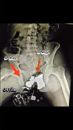 FISTULOGRAM Right and left perineum region.