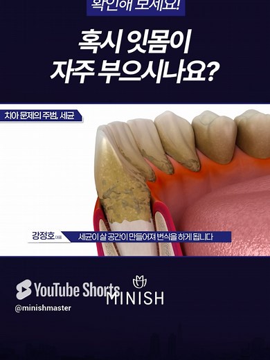 잇몸이 자주 부으시나요? 치주질환 풍치일 수 있습니다 #잇몸치료 #치주질환 #풍치 #풍치치료 #강정호원장 #미니쉬치과병원