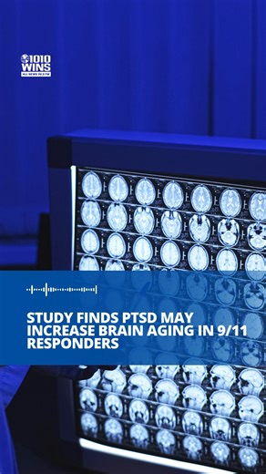 A study conducted by researchers at Mount Sinai concluded that post-traumatic stress disorder (PTSD) may be linked to accelerated brain aging among World Trade Center (WTC) responders. An AI model was specifically trained on 11,000 MRI scans and used to accurately estimate the "brain age" of 9/11 first responders who had been diagnosed with PTSD. Researchers found that the brains of the first responders with PTSD were observed to look significantly older than their actual chronological age. This