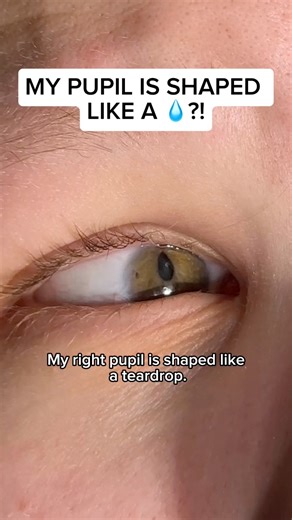 #Blind #LowVision #Eye #Eyes #Disabled #Disability #Reel #Viral #Deaf #HardOfHearing #Mobility #MobilityAid #Accessibility #Education #Educating #Teaching #Surgery #Health #Hospital #Heterochromia | Cassidy Huff