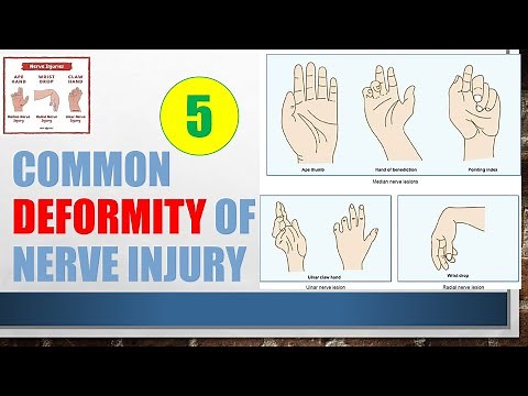 Deformity of nerve injury, Claw hand, Wrist drop, Foot drop, Ape hand, Hand of beneduction