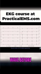 EKG Reading Explained: Spotting Sinus Bradycardia in Seconds! #shorts
