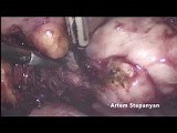 Laparoscopic Myomectomy • Video • MEDtube.net