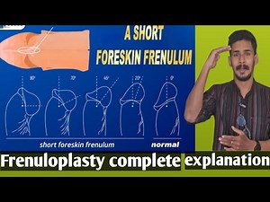 frenuloplasty complete procedure explanation