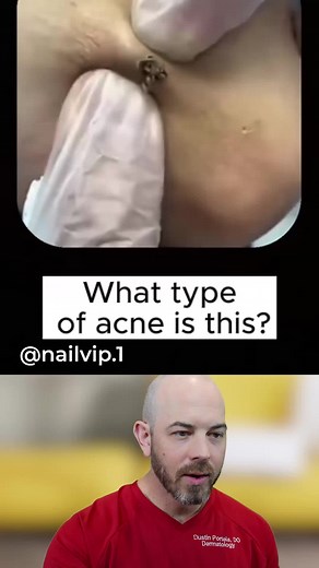 Understanding Acne and Cysts: Key Differences Explained