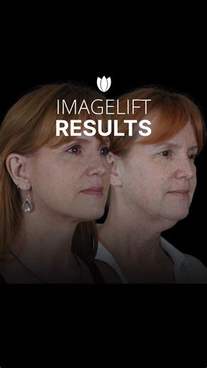 ✨A Lift So Natural, All They’ll Notice Is Your Glow.✨ The ImageLift®...
